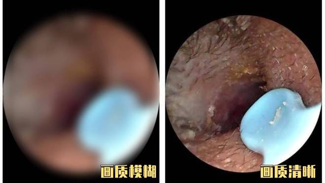 ？挖耳勺到底怎么选？十大品牌测评分享！pg模拟器电脑版带摄像头的挖耳勺好用吗(图13)